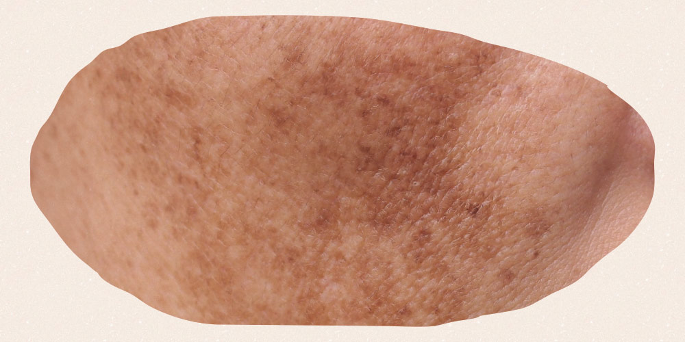 Melasma voorbeeld huid