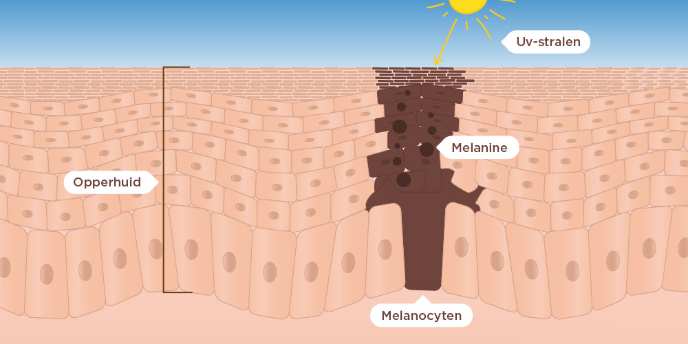 Ontstaan Melasma